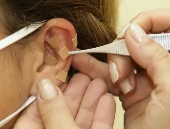 Auriculoterapia pacote